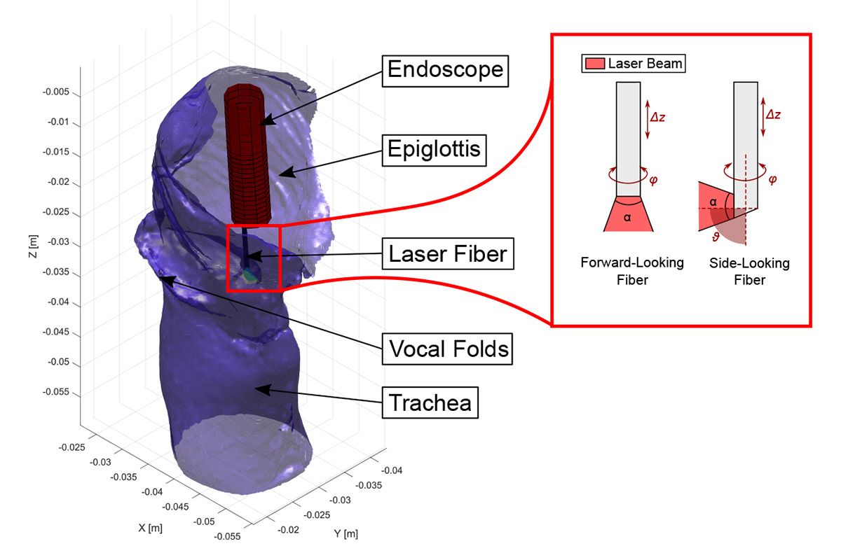 Una simulazione della laringe che mostra l'endoscopio inserito, l'epiglottide, le corde vocali e la trachea. Il modello laser a destra mostra che la fibra orientata lateralmente ha un movimento fino a 90 gradi rispetto alla fibra orientata in avanti.