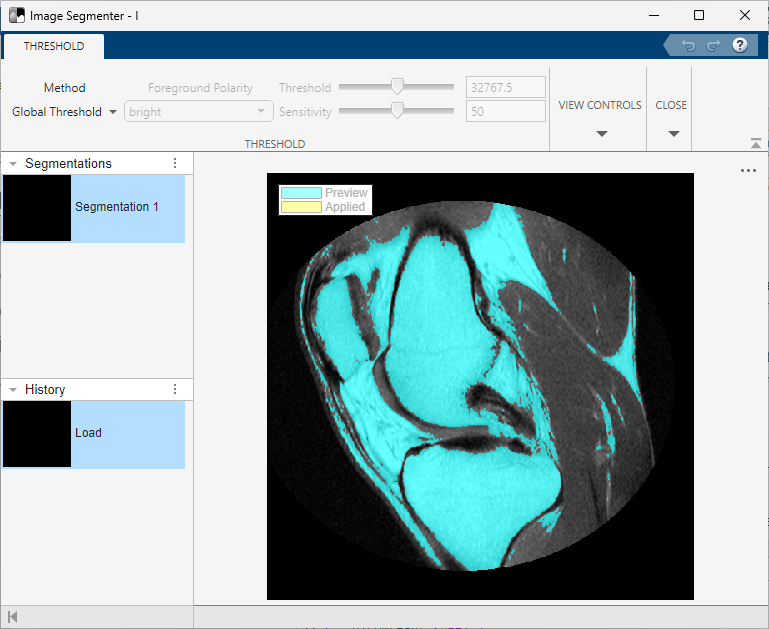 Image Segmenter app showing a scan of a human knee with global thresholding.
