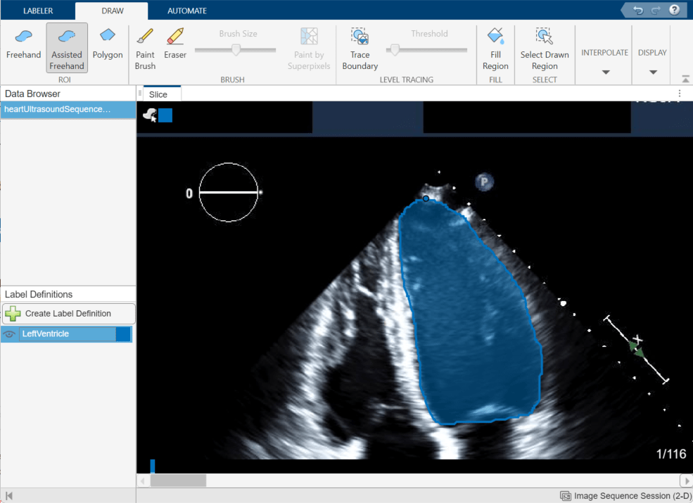 Medical Image Labeler app window showing ventricle labeled in the first frame
