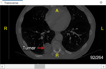 Transverse slice pane with arrow pointing to the lung tumor