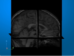 MRI volume displayed as anatomical slice planes using the volshow function