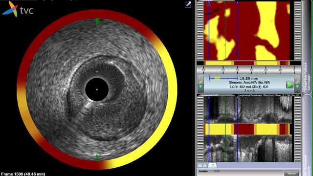 Infraredx accelera lo sviluppo di FPGA su un sistema di imaging intravascolare, unico nel suo genere